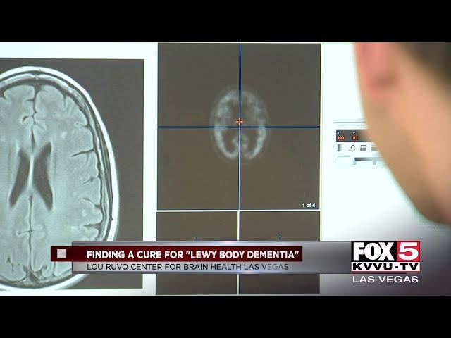 Finding a cure for Lewy body dementia