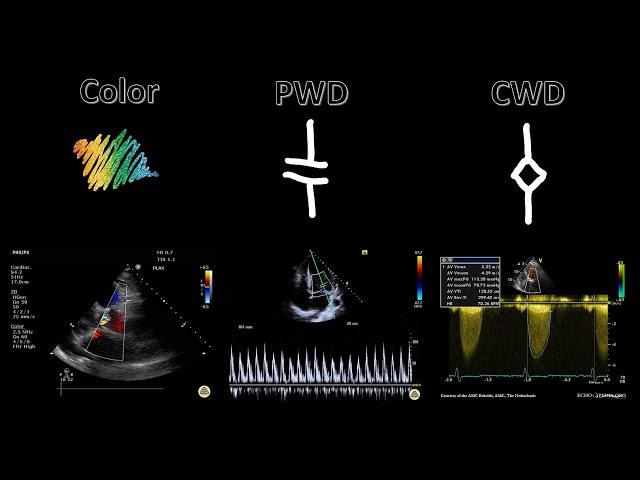 Spectral Doppler