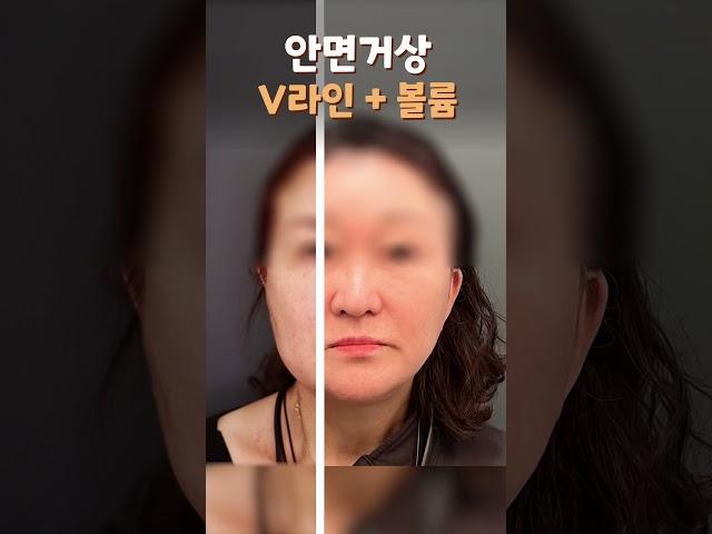 늘어진 턱선 & 목선 당기고 10년 젊어지기