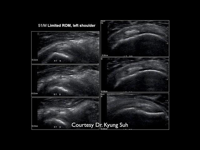 Bones & Inflammation   Pt 4