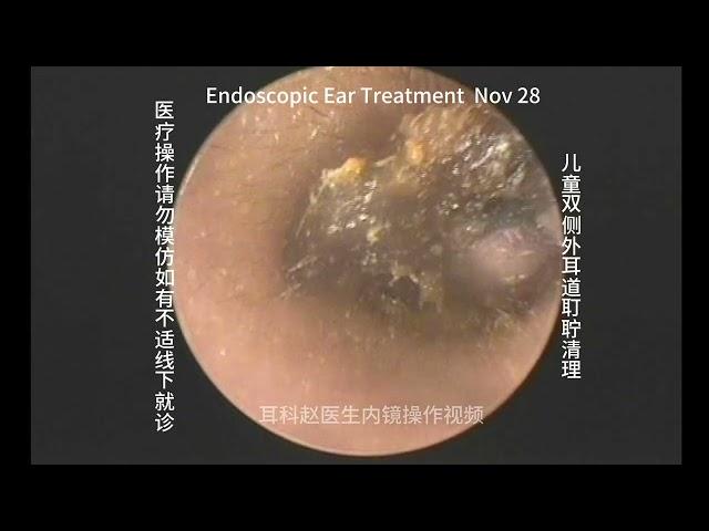 Cleaning of bilateral external auditory canal cerumen embolism in children 20241128