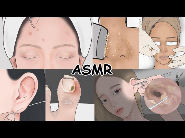 Pimple popping, Ear Wax, Ingrown toenail / Super Satisfying ASMR Compilation! LULUPANG Anime