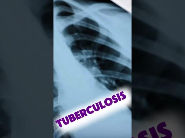 5 Must-Know Facts About Tuberculosis 🫁#nursing  #microbiology