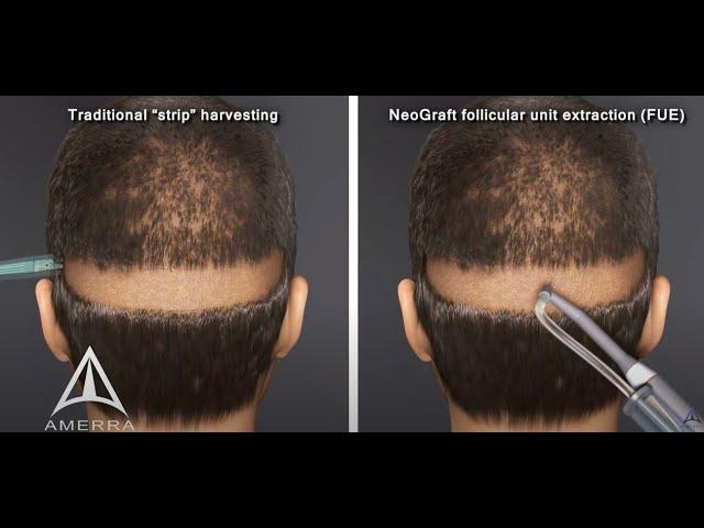 NeoGraft hair transplant procedure - animation