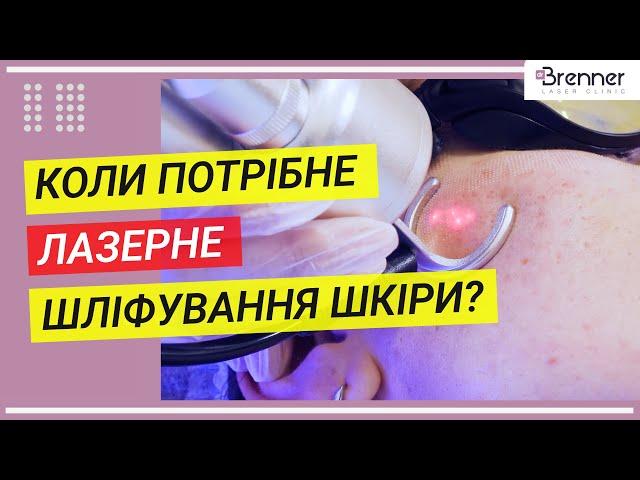 Лазерная шлифовка лица | Brenner Clinic | Клиника доктора Бреннера