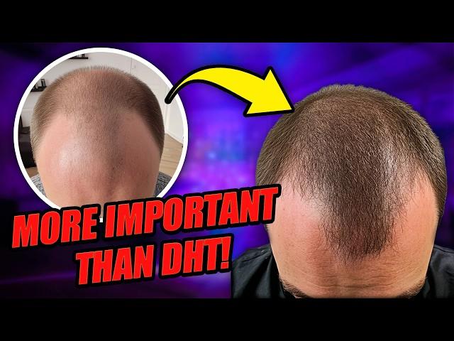 Is DHT The ONLY Cause of Male Hair Loss?