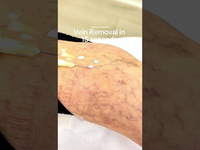 Non-Surgical Vein Removal