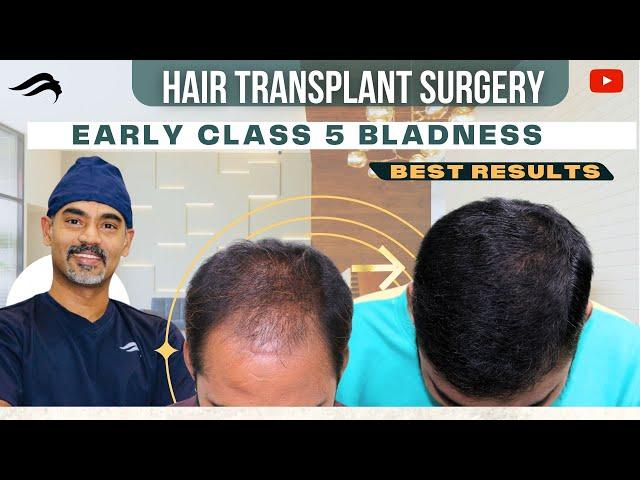 Hair Transplant In Bangalore | Best Surgeon Cost &  Results  Of Hair Transplant In Bangalore