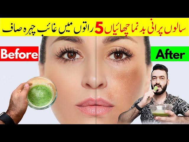 20 years old Pigmentation will completely disappeared in 5 nights | Get Rid of Pigmentation melasma