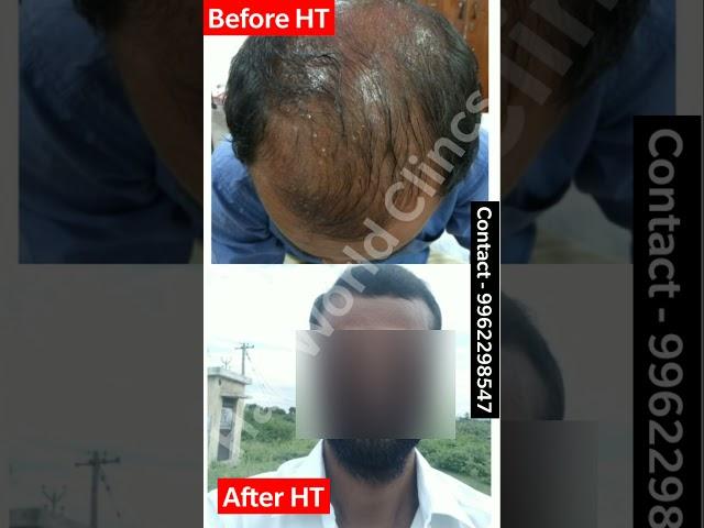 Best Hair Transplant Results in Tamilnadu | Before & After HT Results | Hair World Clinics