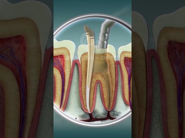 Root Canal Treatment | Curveia Dental I RCT