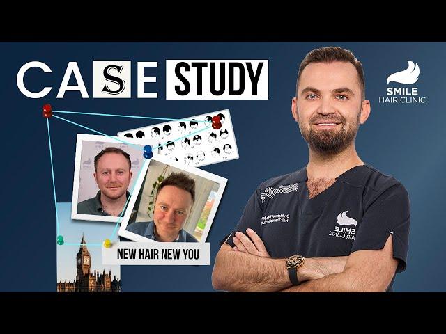 Case Study: 4350 Grafts Transformation | 12-Month Journey with Dr. Erdoğan