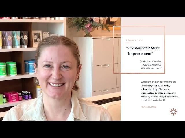 Josie's BBL Treatment Experience at 8 West Clinic, Vancouver BC