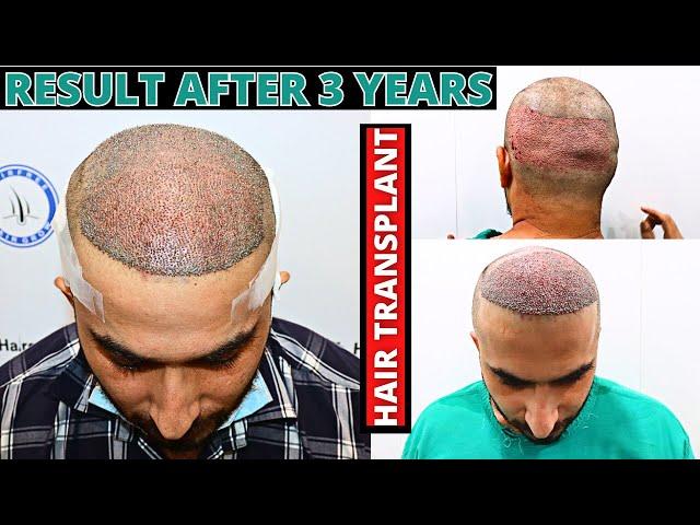 Hair Transplant Result after 35 Months | hair transplant fail | Born Creator