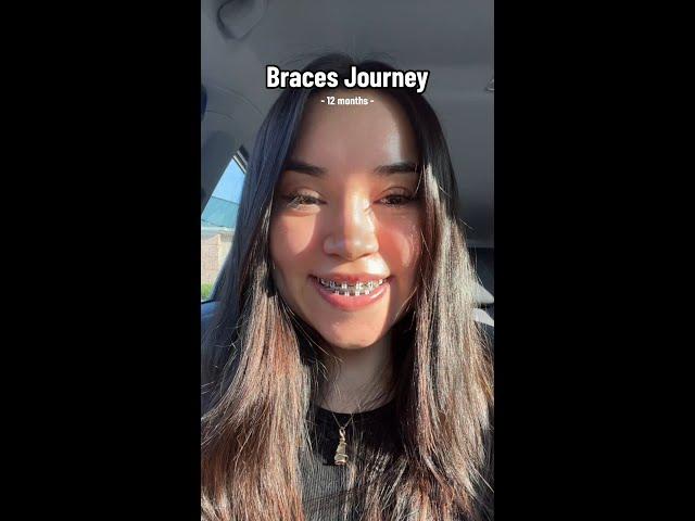 LightForce Braces Transformation