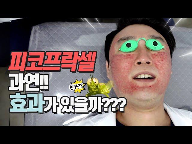 여드름흉터원정대 6탄. 피코프락셀. 여드름 흉터에 과연 효과가 있을까??