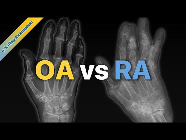 Osteoarthritis (OA) vs Rheumatoid Arthritis (RA): Explained! (+ X-Ray Examples)