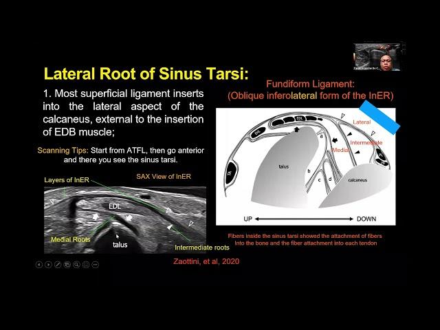 Dr. Jeimylo de Castro talks about advance MSK Ultrasound of the Midfoot ligaments