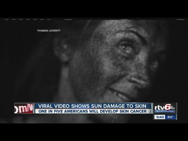 Video: UV camera shows harsh realities of sun damage