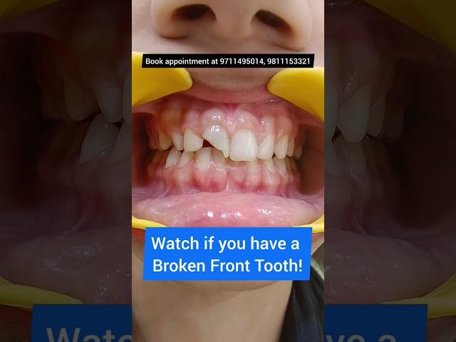 Broken Front Tooth? Fix it NOW! Dr. Srishti Bhatia #teeth #dentist