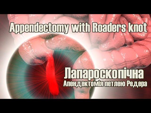 Appendectomy with Roaders knot / Апендектомія петлею Редера