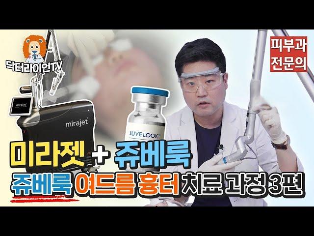 닥터라이언이 직접 보여주는 쥬베룩 여드름 흉터 치료 과정 3편 (미라젯 + 쥬베룩)