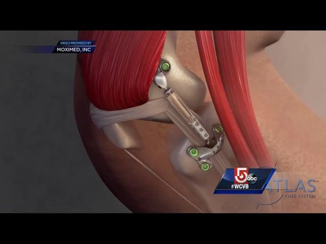 Could patients avoid knee replacement surgery with new implant?