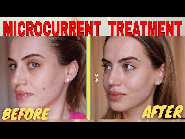 MICROCURRENT FACIAL BEFORE AND AFTER | NUOVALUCE MICROCURRENT REVIEW 2021 | Madella Beauty