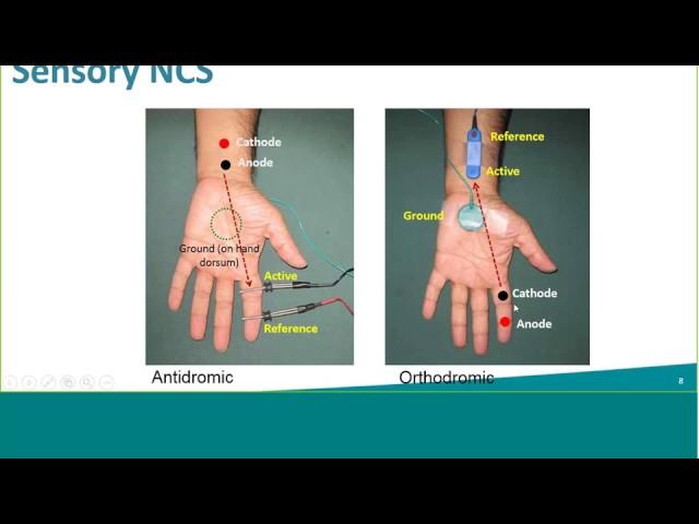 Natus NCS Webinar: Sensory NCS: Reducing Noise, Interference, & Artifacts