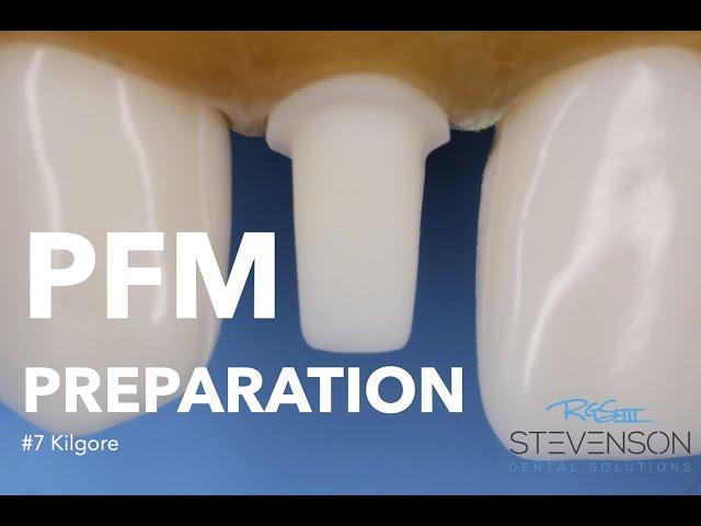 PFM Preparation on Tooth #7 Kilgore | Stevenson Dental Solutions