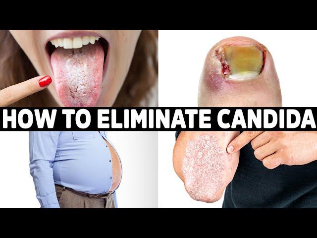 NEVER Get Candida Again