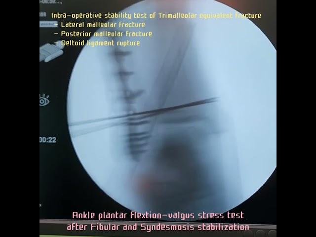 S16.Intra-op. Syndesmosis/Deltoid ligament stability test in Trimalleolar equivalent fracture[강함정이]