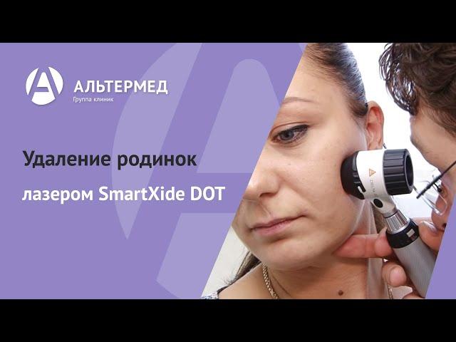 Альтермед. Удаление родинок лазером SmartXide DOT