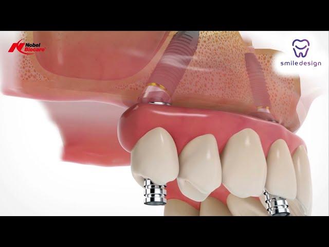 Prótesis Dentales Fijas All On 4 Implantes Dentales