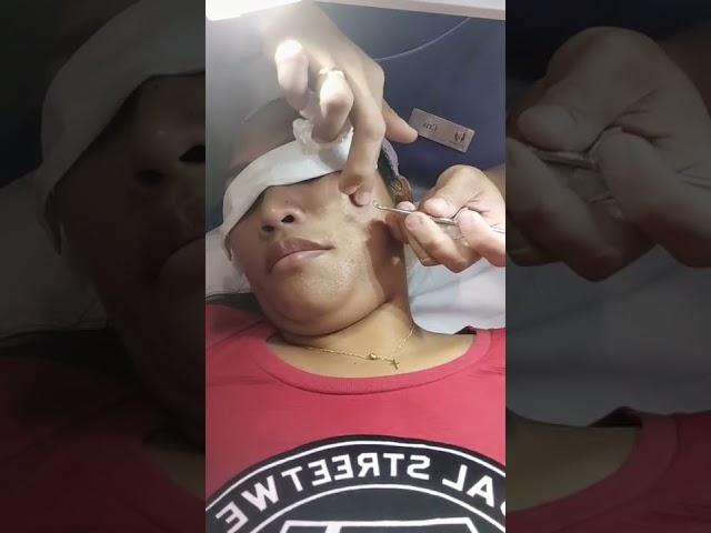 HAVING ACNE TREATMENT #merryjuj #shorts #shortvideo #acne #acneremoval #acnetreatment