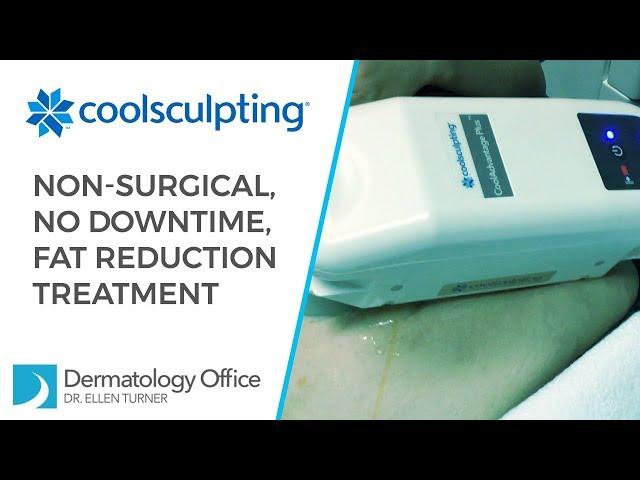 CoolSculpting for Non-Surgical Fat Reduction