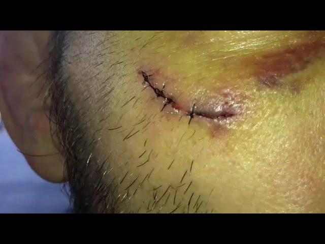 Jon Fitch 20 Days Of A Cut