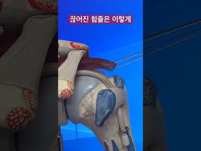 끊어진 힘줄은 이렇게 붙입니다 [날아라정형외과 관절수술센터]