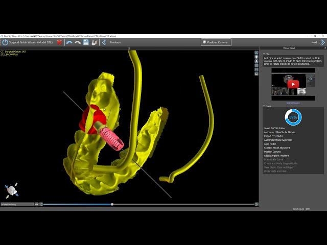 BSP4.9 - Step by Step Implant Planning Wizard