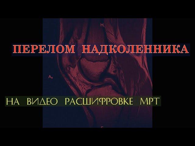 ПЕРЕЛОМ НАДКОЛЕННИКА с формированием ЛОЖНОГО СУСТАВА на ВИДЕО РАСШИФРОВКЕ МРТ коленного сустава