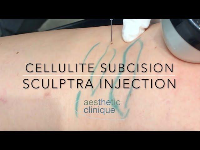 Cellulite Subcision Sculptra Injection done with Blunt Cannulas by Dr. Steven F. Weiner