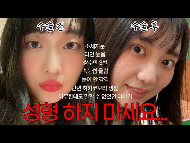 쌍수 망하고 히키코모리 된 이야기... | 예쁜 눈진격의 거인 닮은 꼴 됨 | 눈 안 감김, 점막 들림, 소세지눈, 라인 높음 | 성형 부작용 ssul