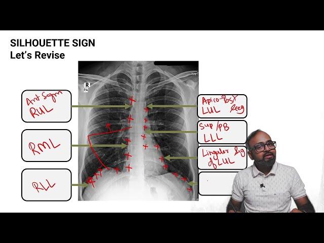 SPOTTERZ - 04 - CXR - Lobar consolidation