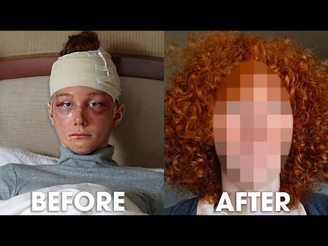 *RESULTS* Before and After MORE Facial Feminization Surgery in South Korea | Season 2, EP 2