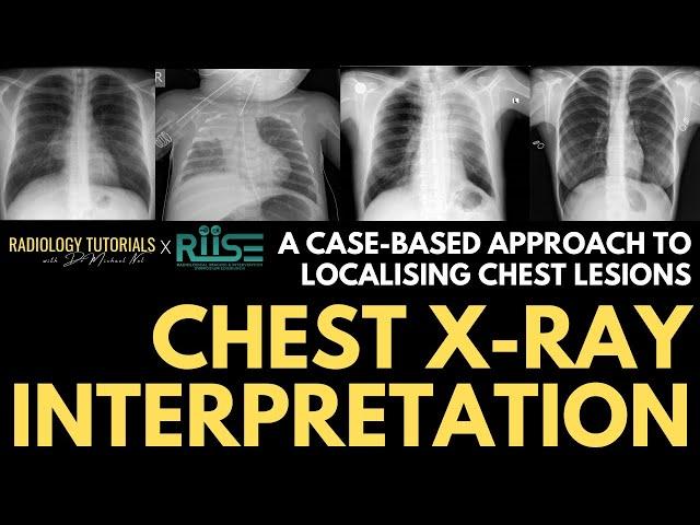 Localising Lesions on Chest Radiographs | A Case-Based Approach | RIISE Workshop