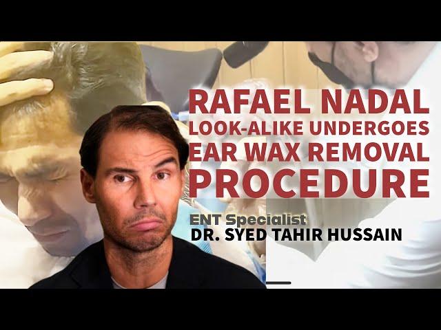 Raffael Nadal’s Look alike Regains Hearing After Removal of Longstanding Impacted Ear Wax