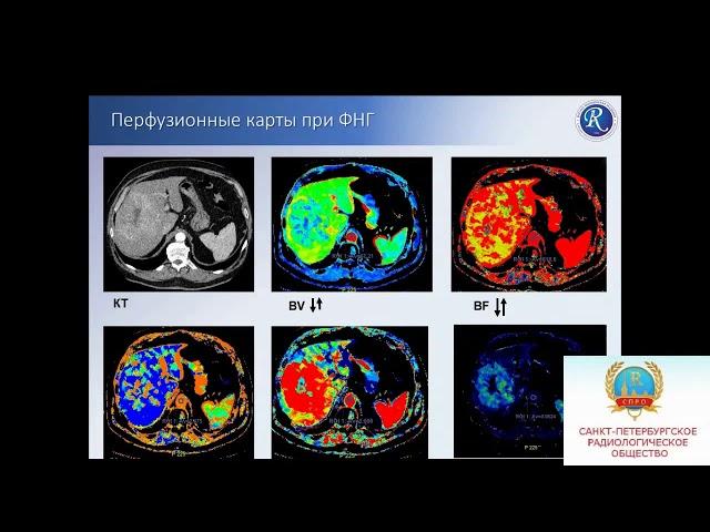 Загорулько Н.А.«Возможности КТ перфузии в диагностике образований печени»
