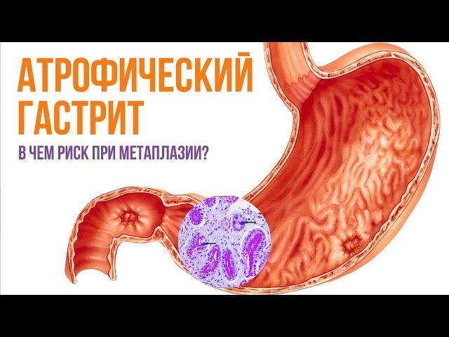 Атрофический гастрит и метаплазия в желудке: прекратить игнорировать, защитить слизистую желудка!