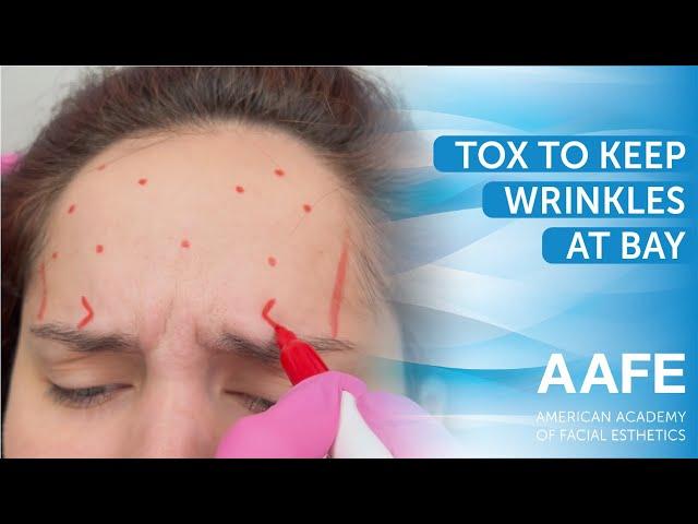 Tox to Keep Wrinkles at Bay