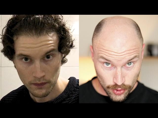 BALDING YEAR 1 vs YEAR 6